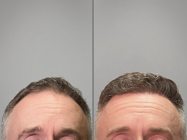 Hair restoration before and after — 2,200 Grafts
