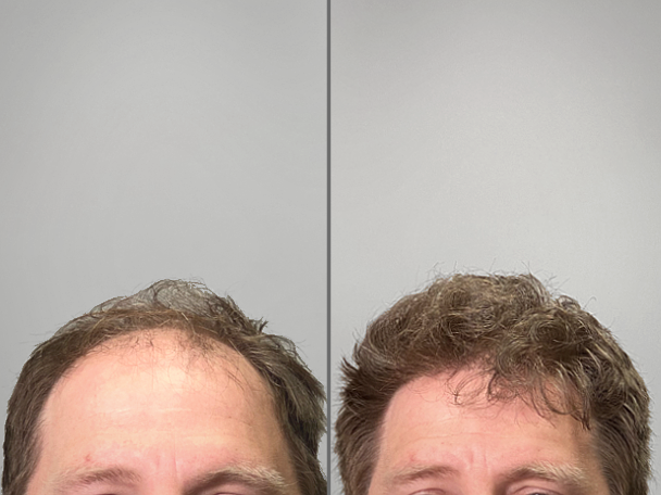 Hair restoration before and after — 2,500 Grafts