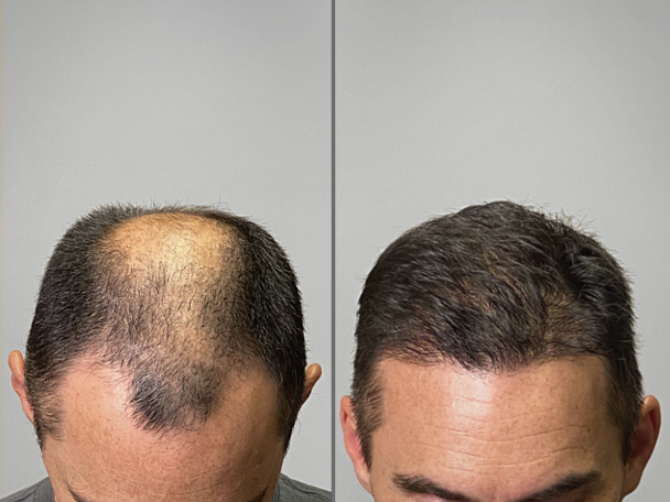 Hair restoration before and after — 2,800 Grafts