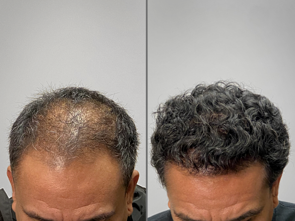 Hair restoration before and after — 2,400 Grafts