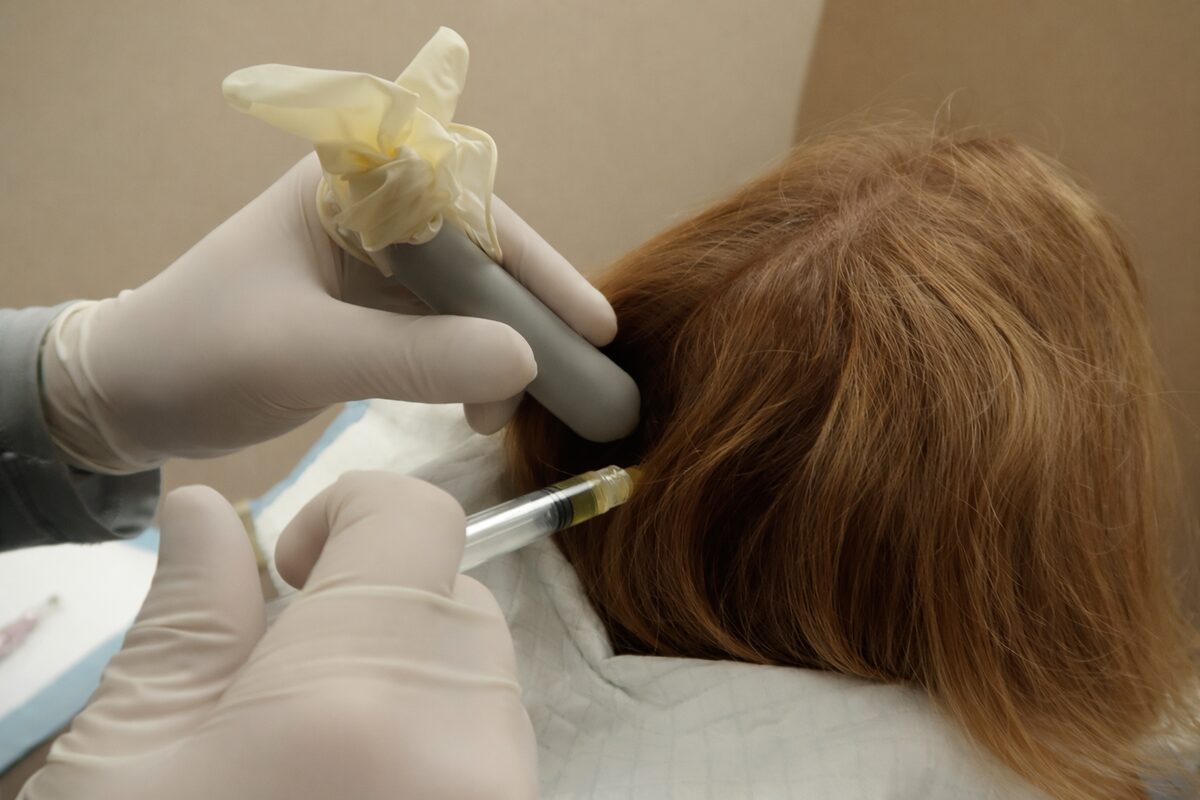 Scalp Injection during PRP hair treatment at Signature Hair Restoration