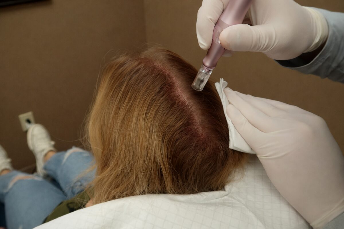 Microneedling during PRP hair treatment at Signature Hair Restoration